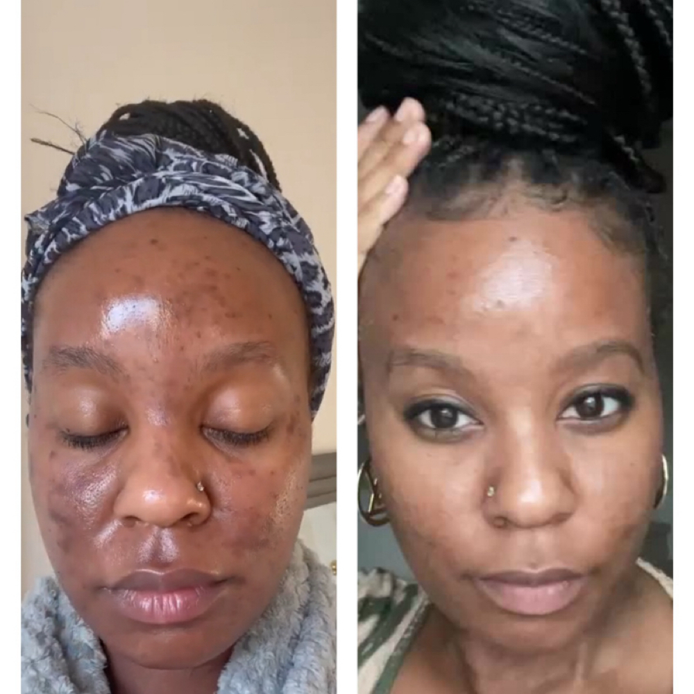 The Glow After Dark Peel at Beauty Therapy by Chanel in Tucker, GA