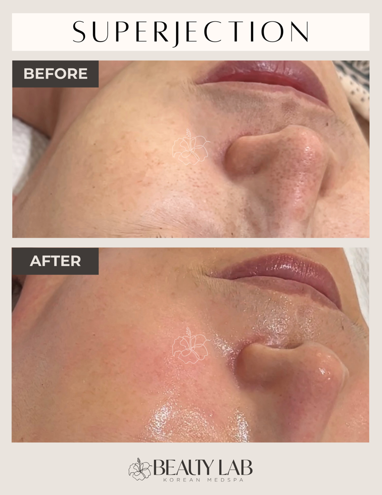 Korean Spicule Peel