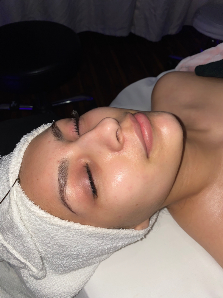 Acne Facial