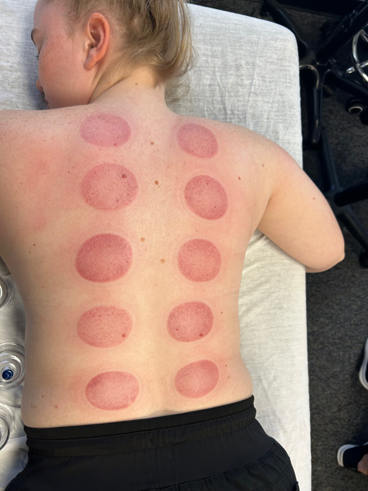 Cupping Massage