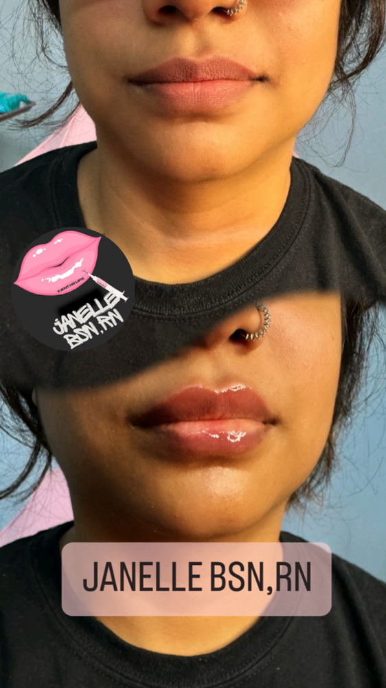 1ML FILLERS MODEL SPECIAL at ˈFæntəsi Lips 👄 in Lewisville, TX