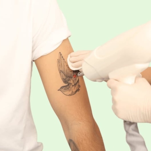 Tattoo Removal at The Skin Bar & Med Spa in Bryant, AR