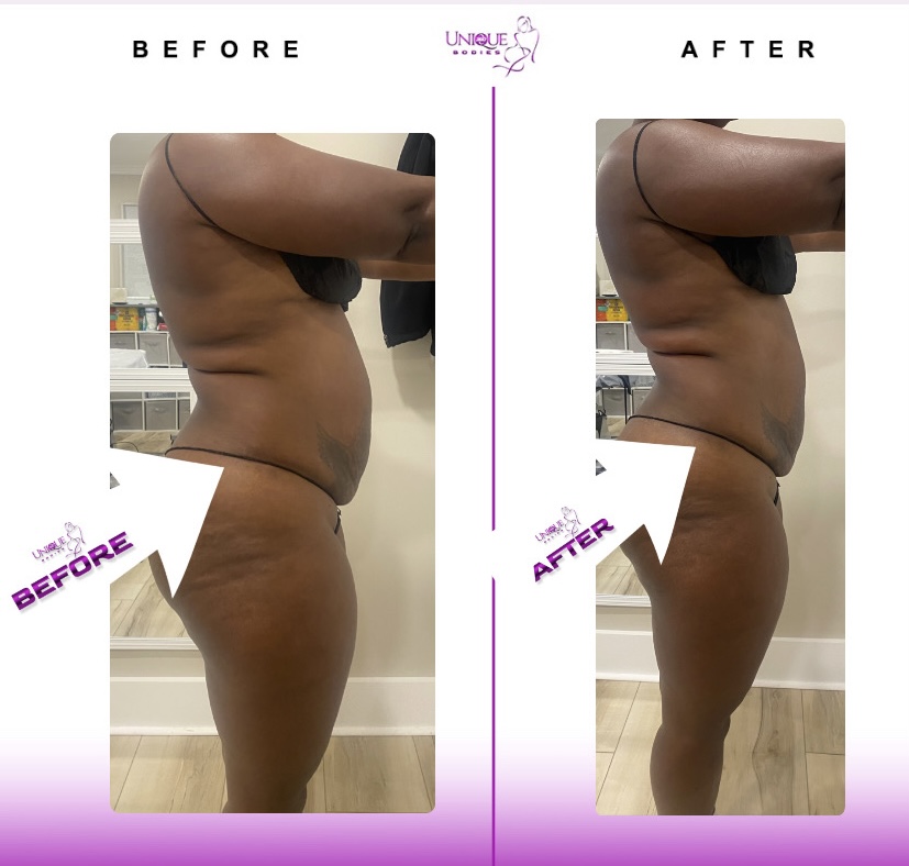 Cavitation Fat Burner