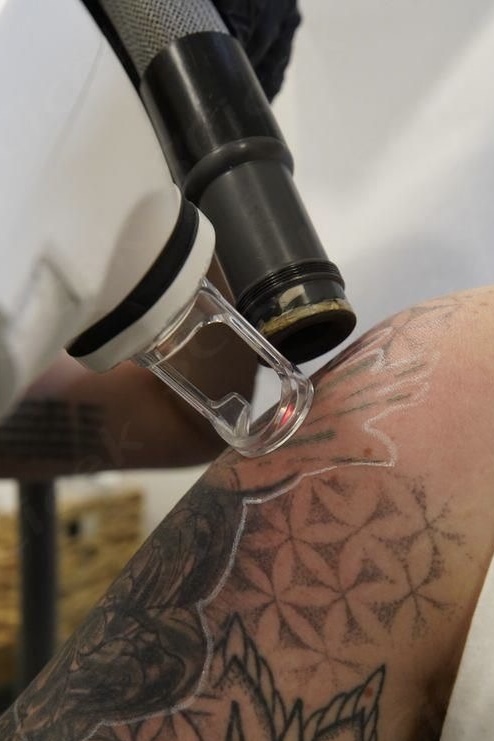 Tatto removal ( Small Tatto )