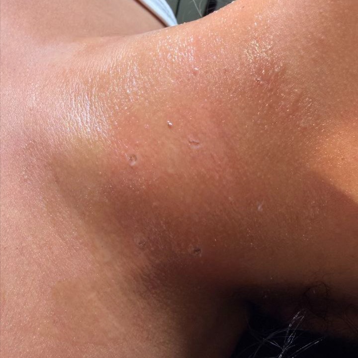 Wart removal at Windys Beauty Studio LLC in Virginia Beach, VA