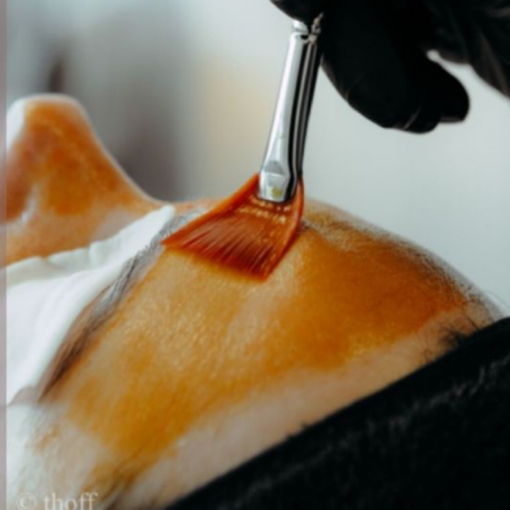 Lactic Acid Chemical Peel at Vance Aesthetics in Mount Orab, OH