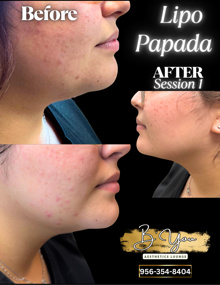 Lipo Papada W/ Lipo Dissolve
