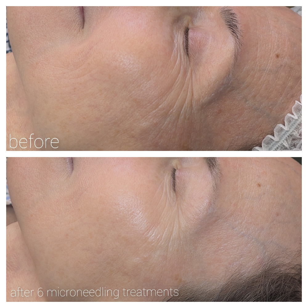 Microneedling