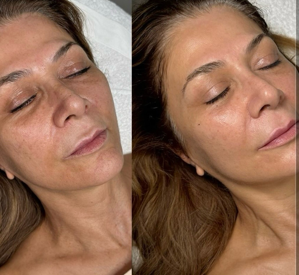 Cryo-therapy + Vital C Peel