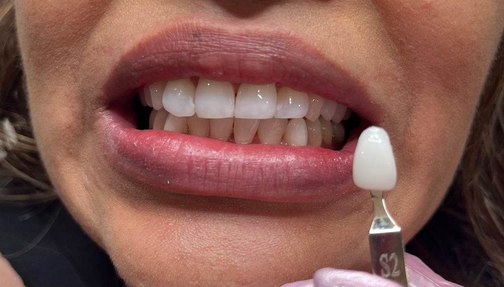 Teeth Whitening