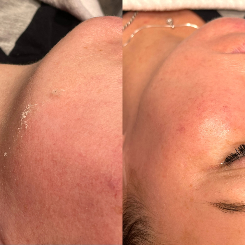 Dermaplaning