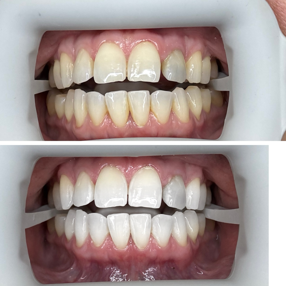 Professional Teeth Whitening