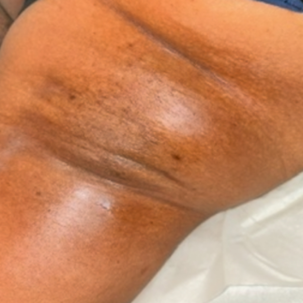 Under Arm Wax at Treasured Living Esthetics in Rosedale, MD
