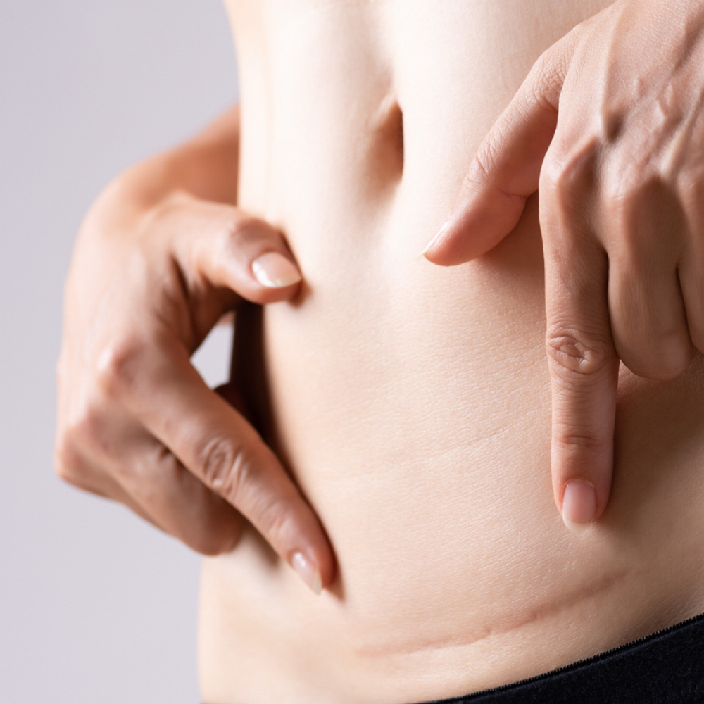 Scar Revision Conulstation