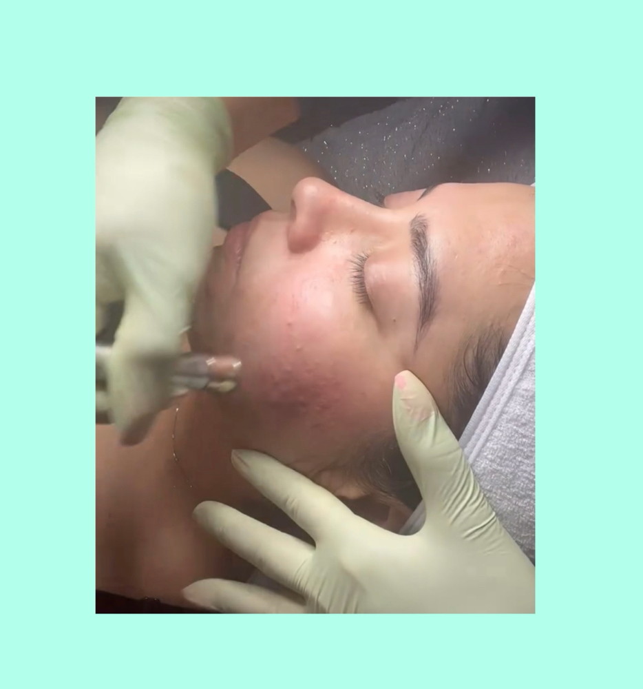 Diamond Tip Glow Facial at Kohinoor Aesthetics By Marissa Elizabeth in San Antonio, TX