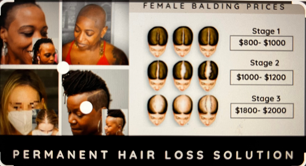 Female Pattern Baldness Ses. 1 & 2