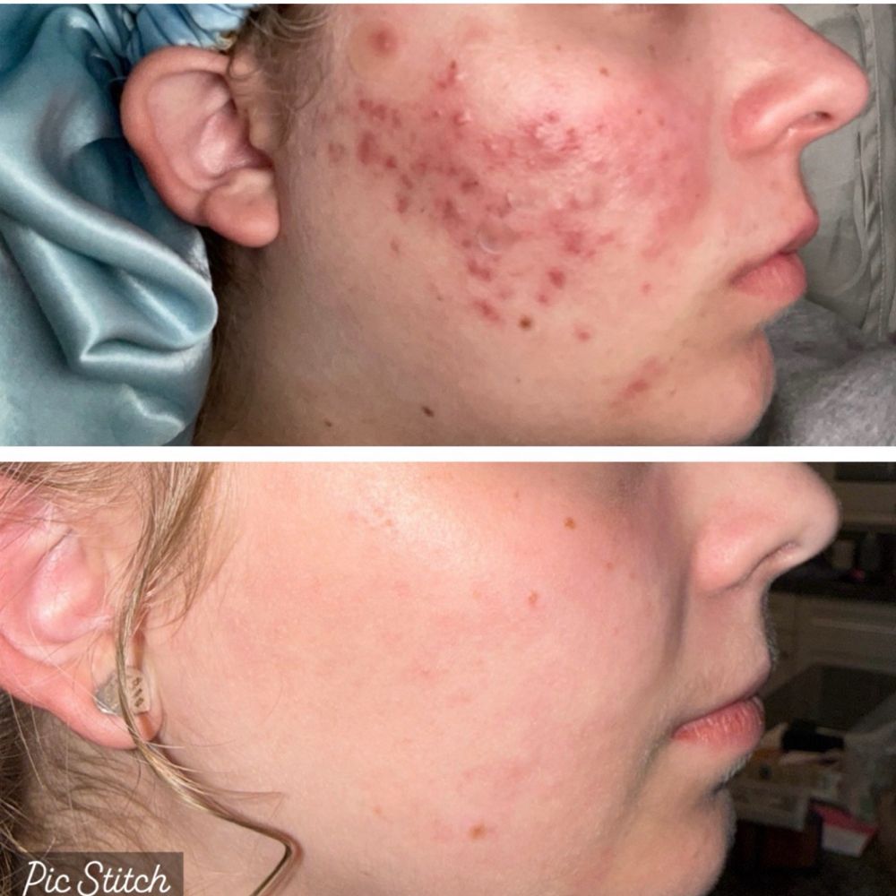 Clear Skin Acne Treatment at Jenni Leanne Aesthetics in Temecula, CA