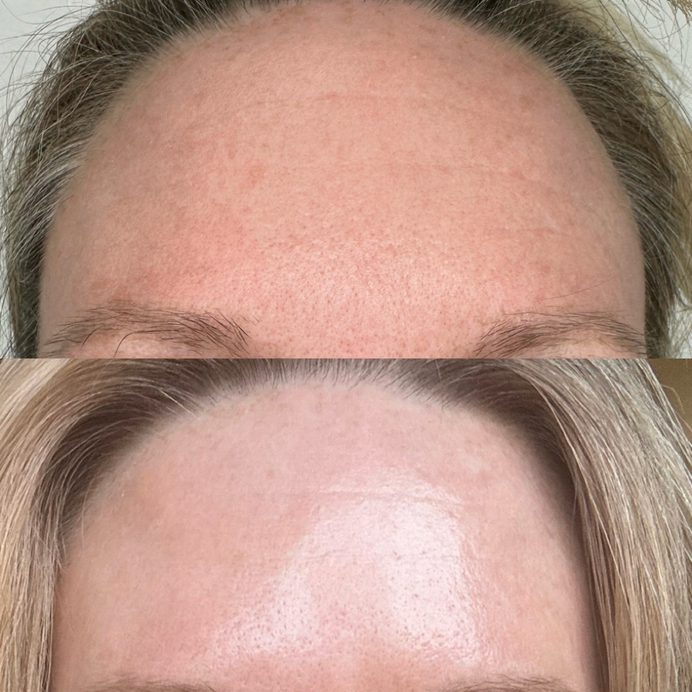 Forhead Lift at Magnolia Plasma Fibroblasting By Mitra in Frisco, TX