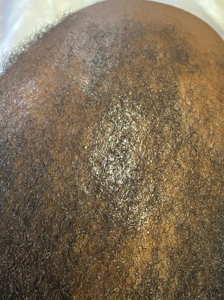 Mens Hair Replacement System