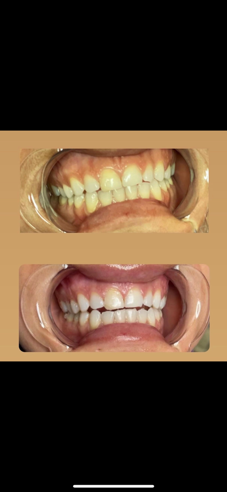 Teeth Whitening 1hr