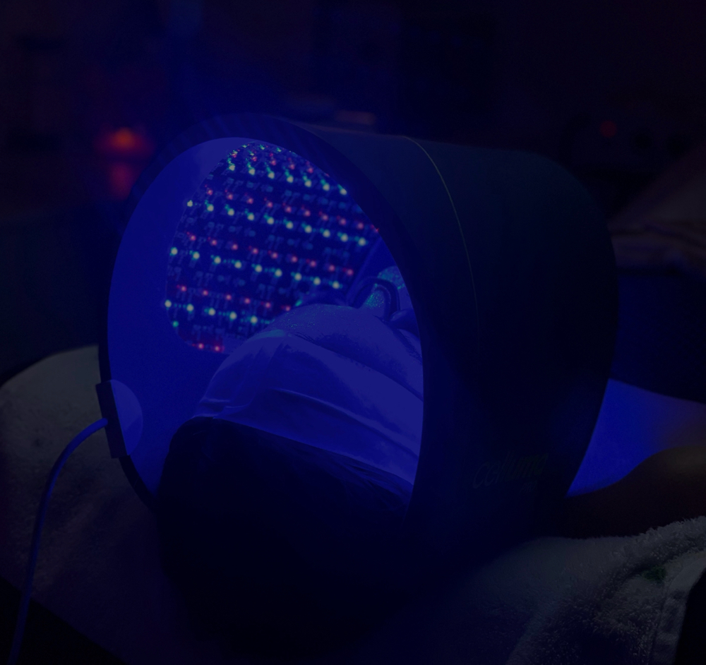 Chemical Peel