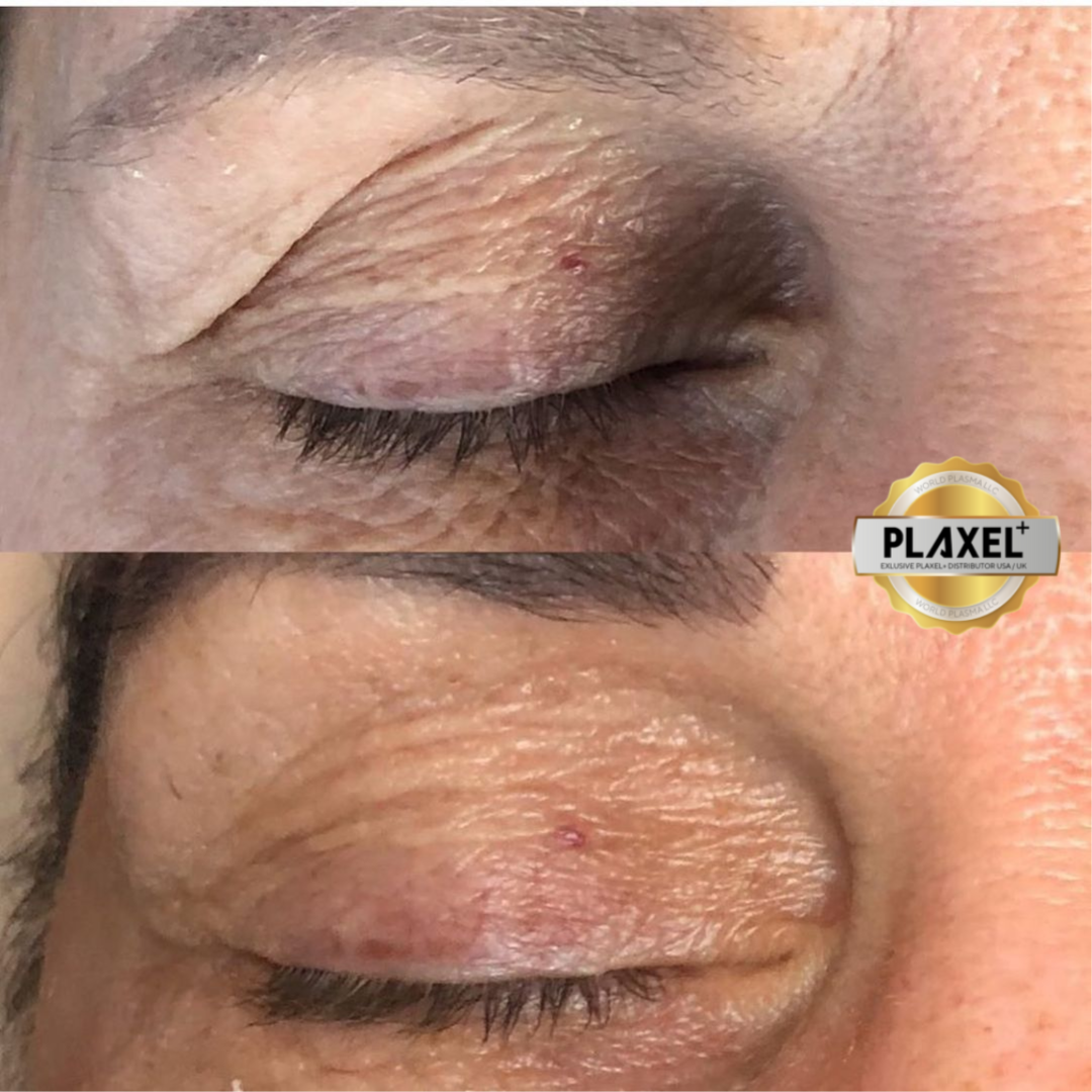 Non-surgical eye tightening at SSKIN in Vancouver, WA