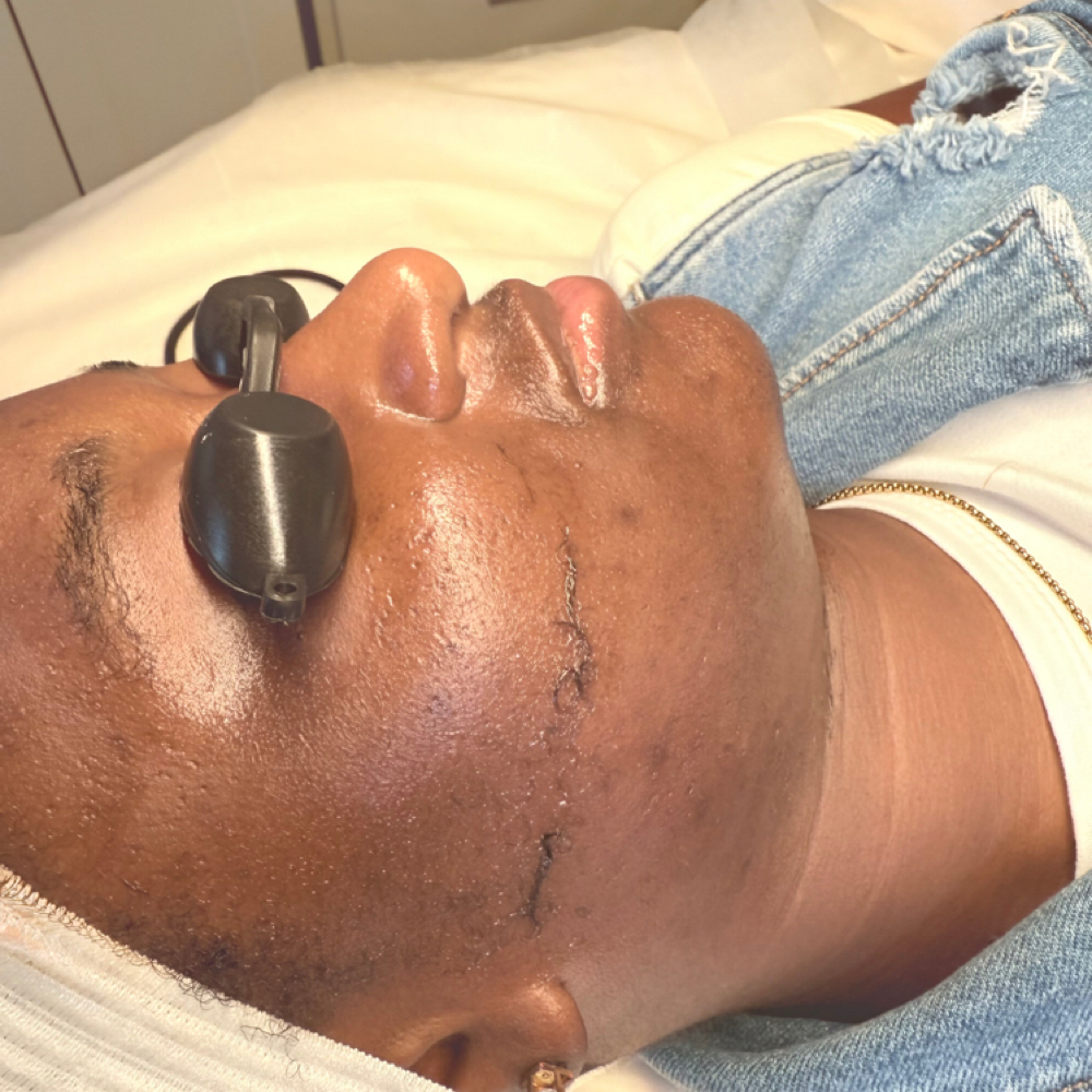 Dermaplaning at Refinery Aesthetics Loft in Oxon Hill, MD