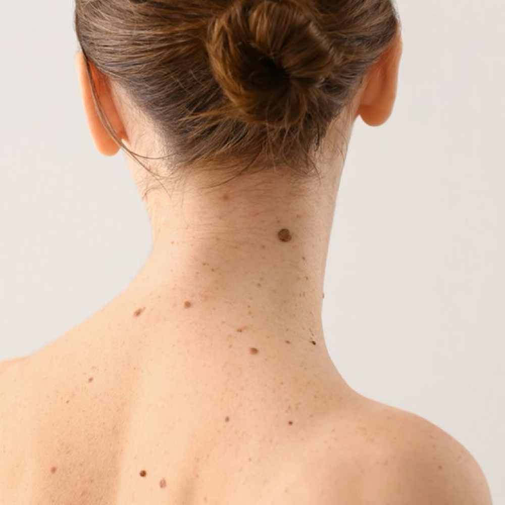 Mole Removal at SkinXKristin in Southlake, TX