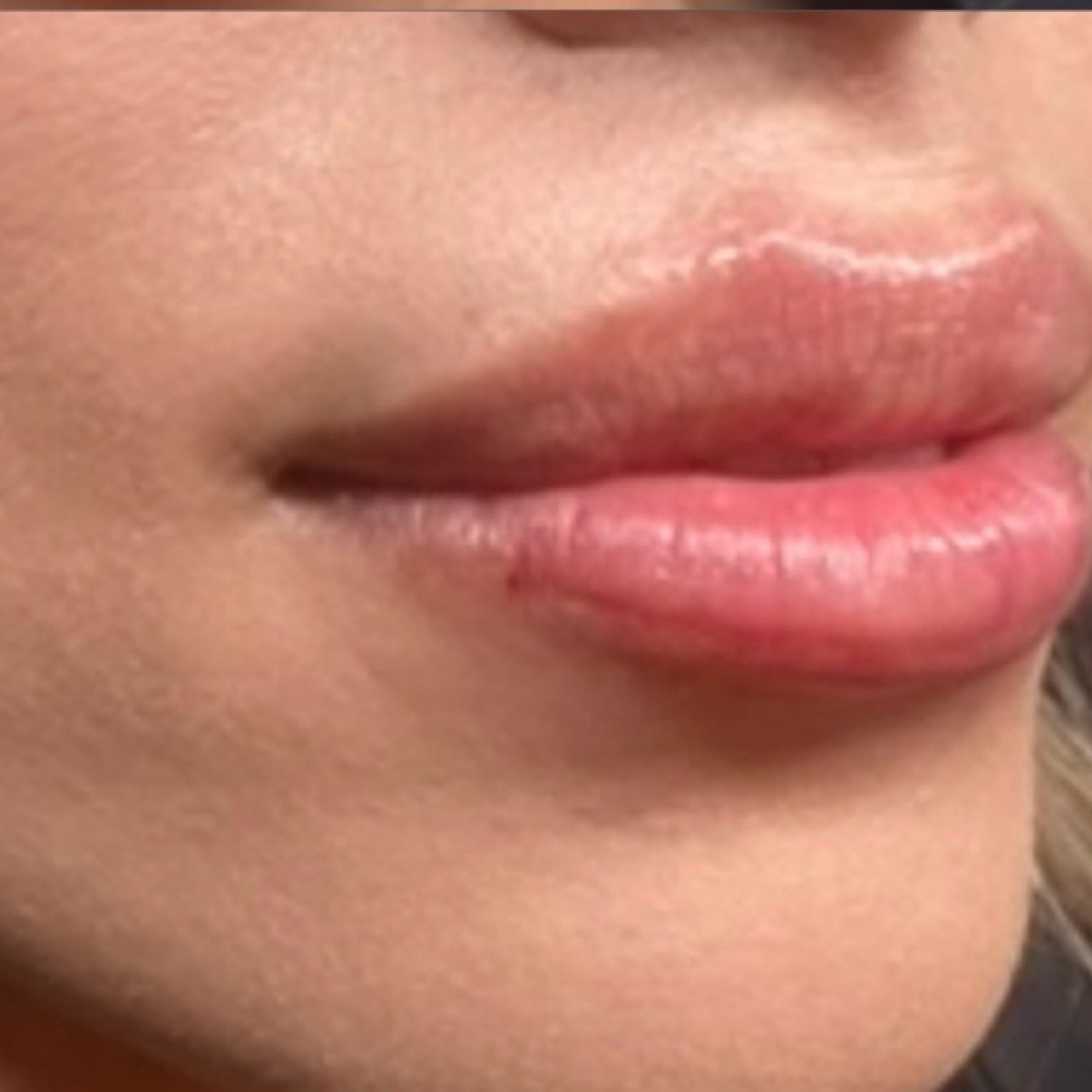 Lip Filler Half at Obsession blessed med spa in Moreno Valley, CA