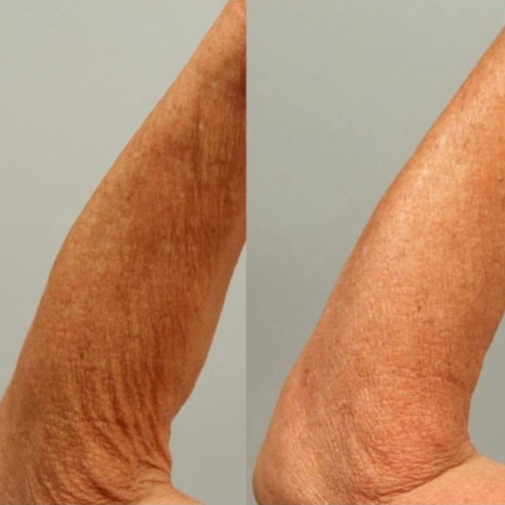 Procell Microchanneling (Arms) at Skin Deep Esthetics in Columbus, MS