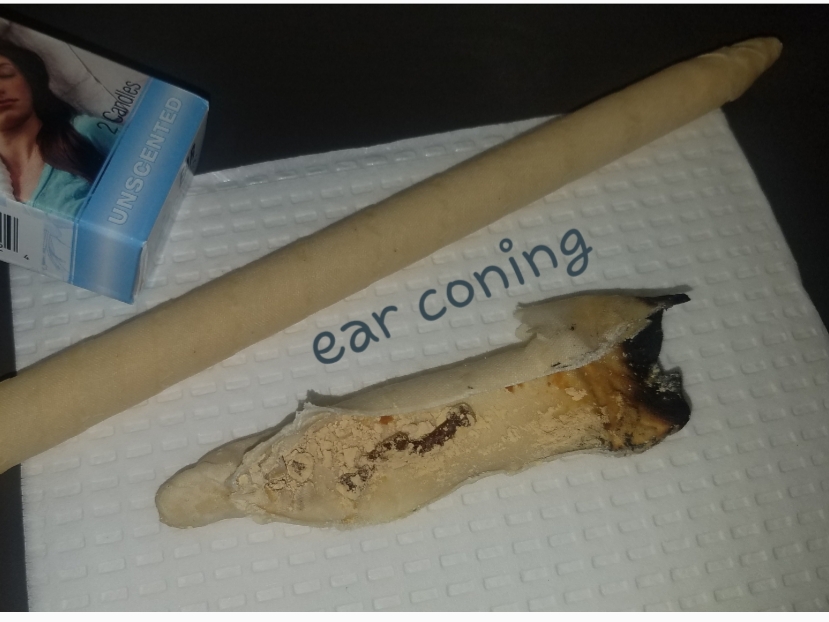 Ear Coning (Candling)