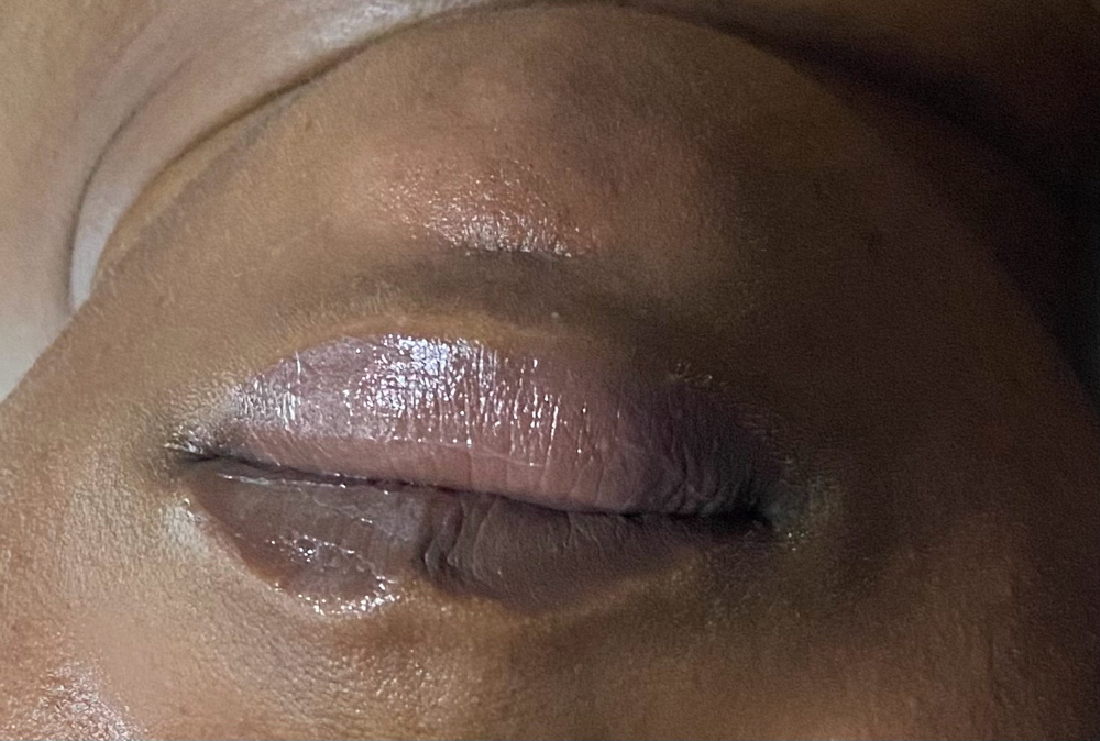 Lip & Chin Hair Removal