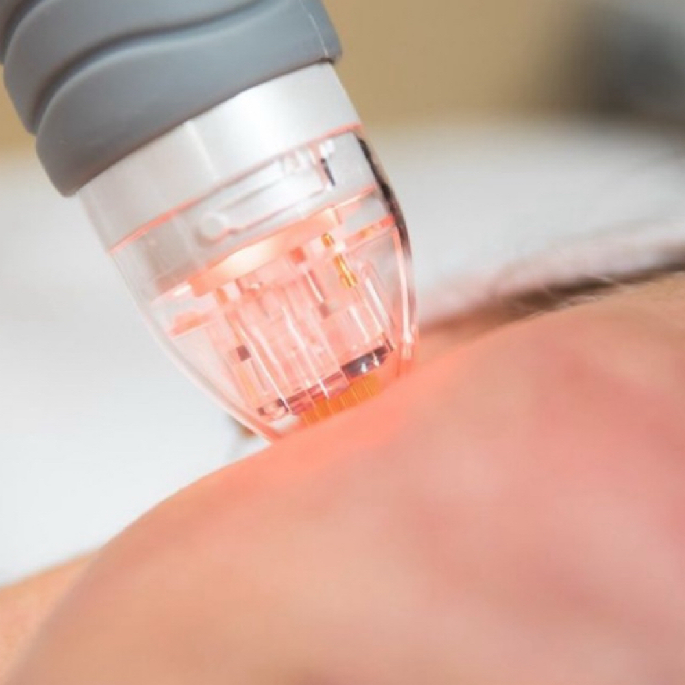 Microneedling with RF at Beauty Lounge Prosper in McKinney, TX