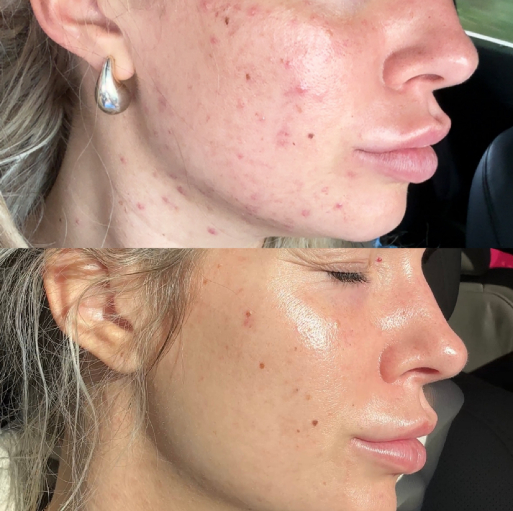 Acne Treatment (Consult Req Prior) at Aesthetics by Taryn in Grand Rapids, MI