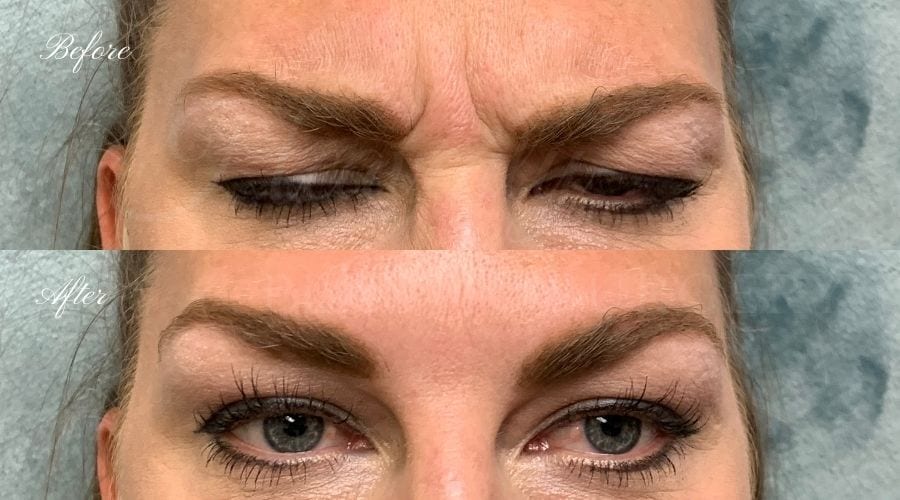 Glabella Botox