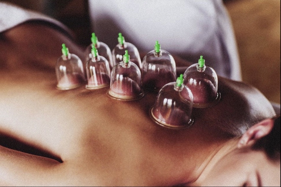 Cupping