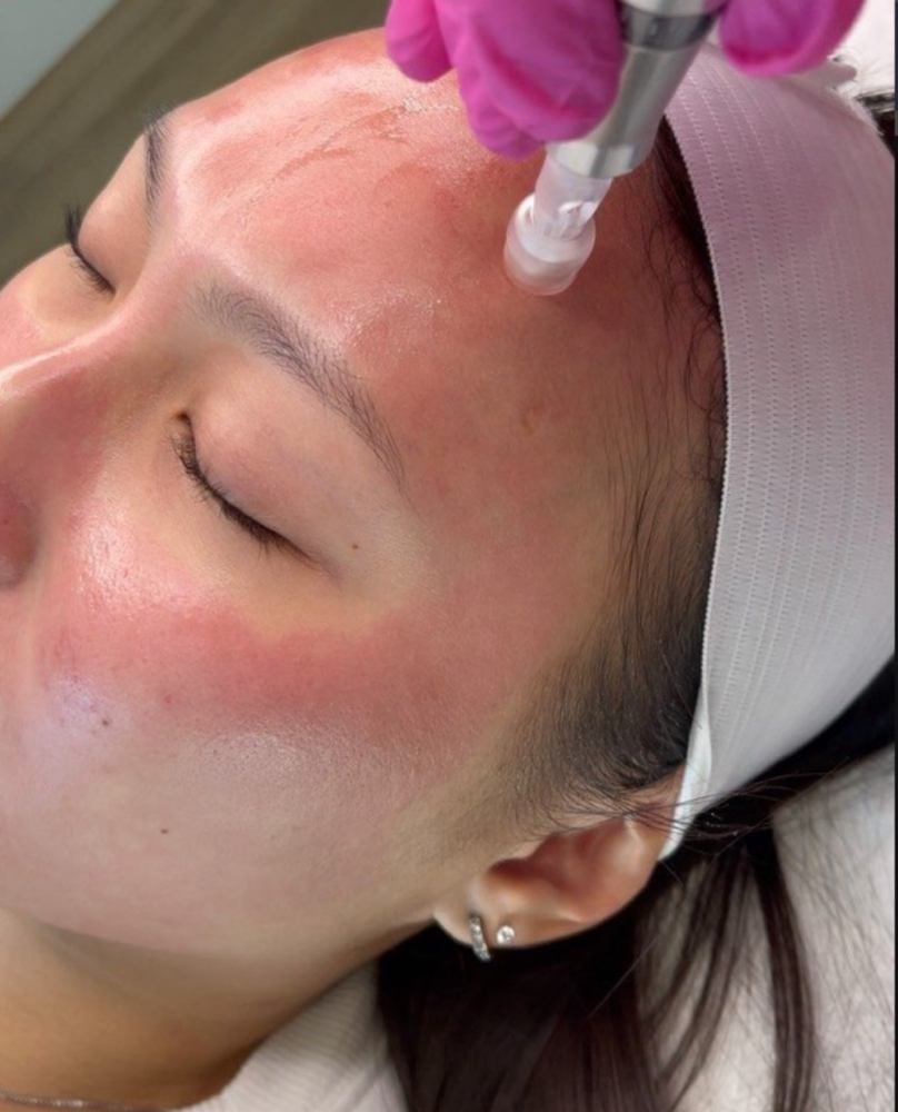 Microneedling
