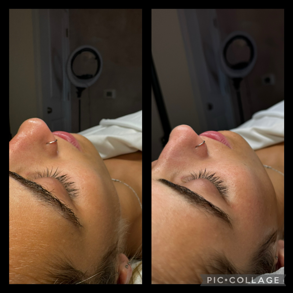 Dermaplane Facial