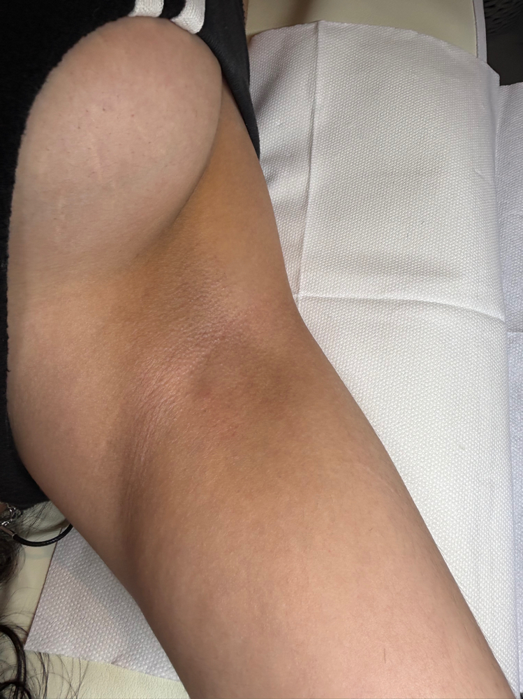 Underarms at Complexion LA in Los Angeles, CA