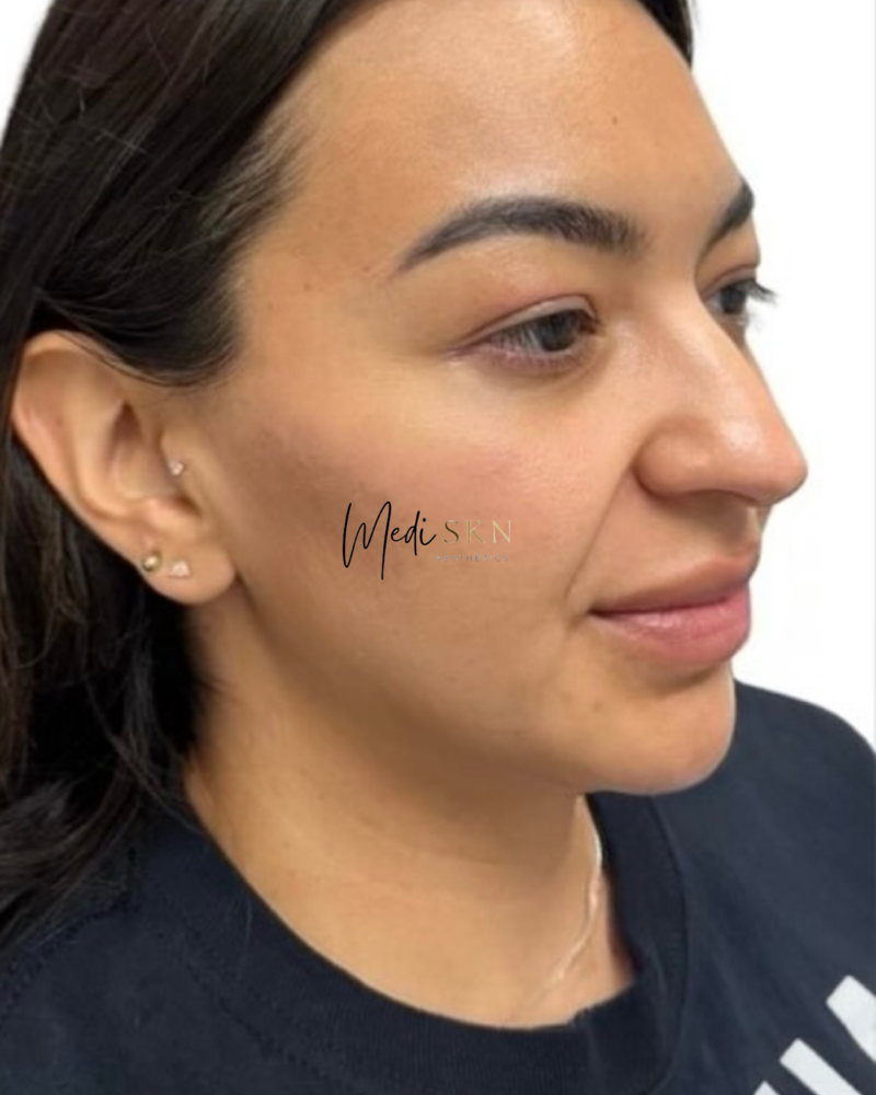 Chin filler