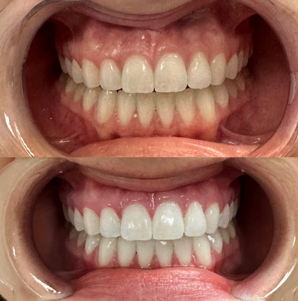Teeth Whitening