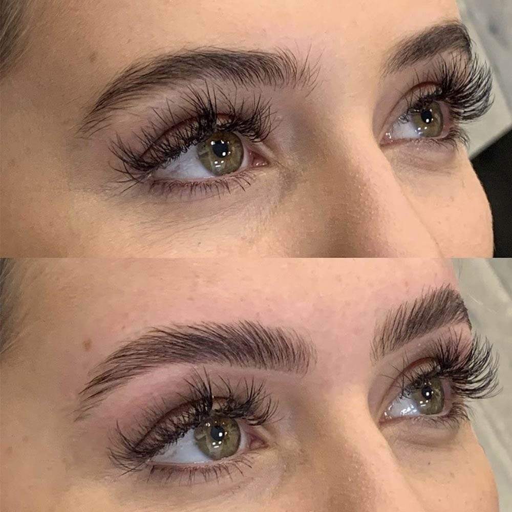 Brow Lift