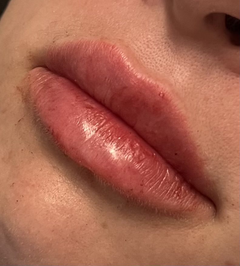 Lip Plump at The Inked Aesthetic Nurse in Coeur D Alene, ID