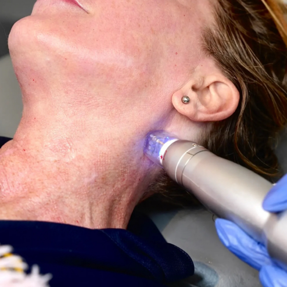 Neck Microneedling at The It Girl Glow in Staten Island, NY