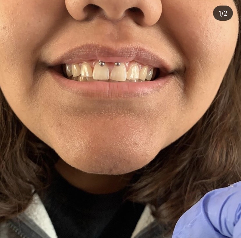 Smiley Piercing