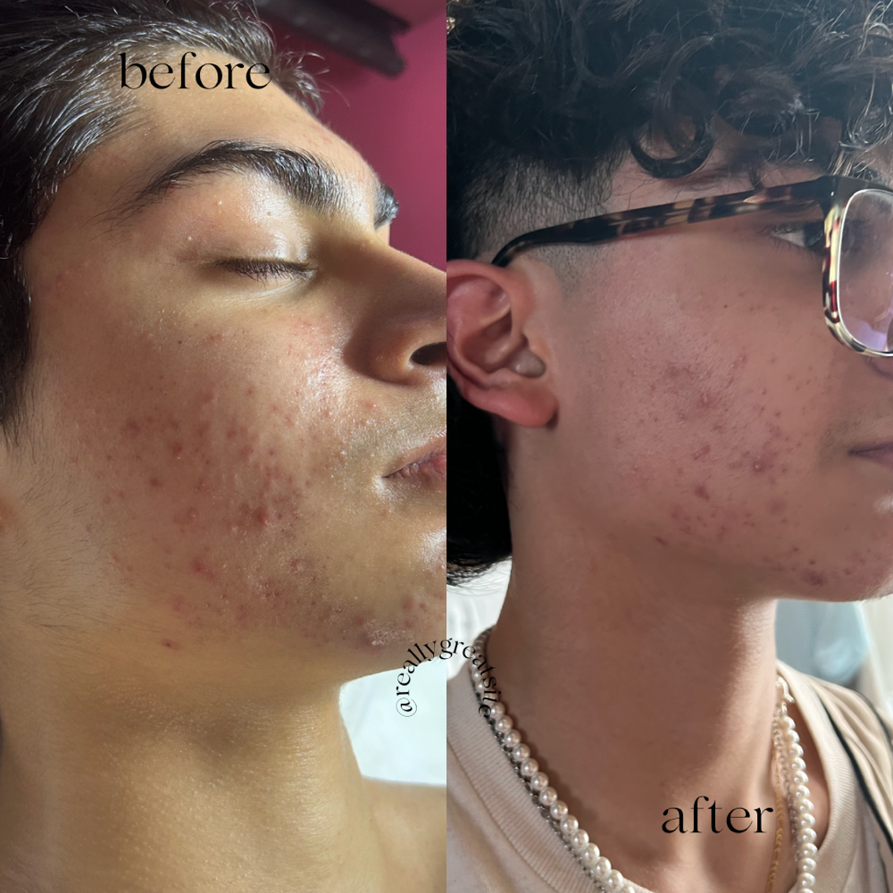 Chemical peel