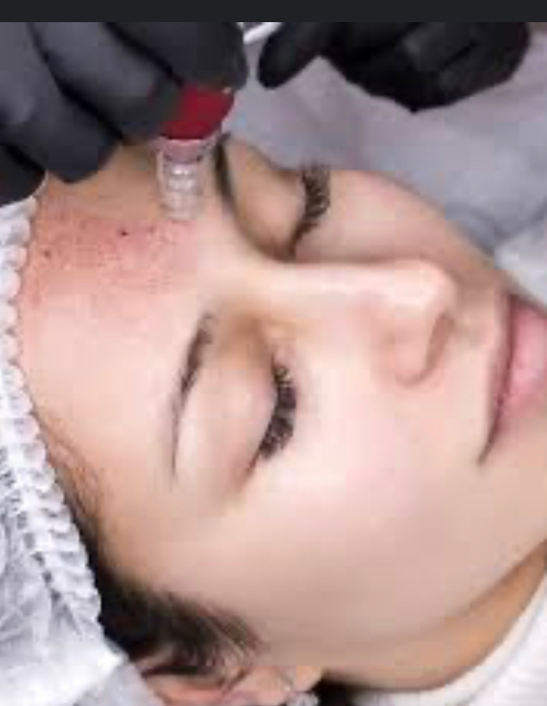 Elite Microneedling