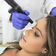 Medical Microneedling w/Exosomes