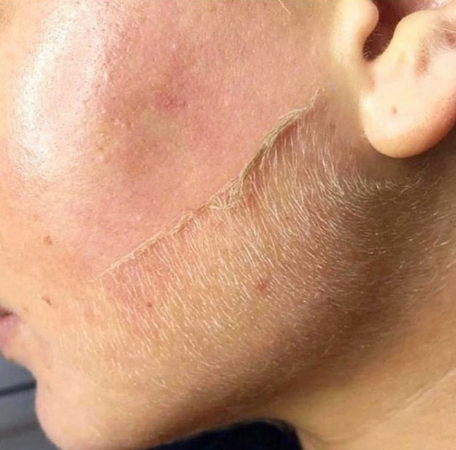 Dermaplane at St Florian’s Soap and Spa in Coeur d’Alene, ID