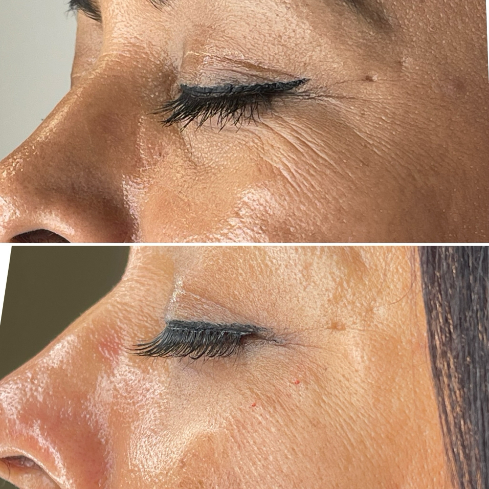 FIBROBLAST PARPADOS ESPECIAL